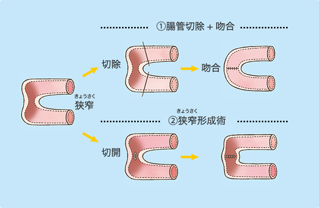 （図）狭窄に対する主な手術方法