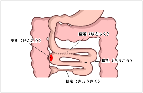 （図）クローン病の主な腸管合併症