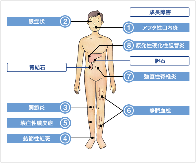 （図）クローン病の主な腸管外合併症