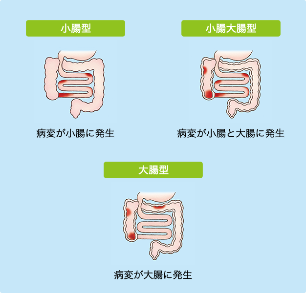 （図）クローン病の病変範囲による分類