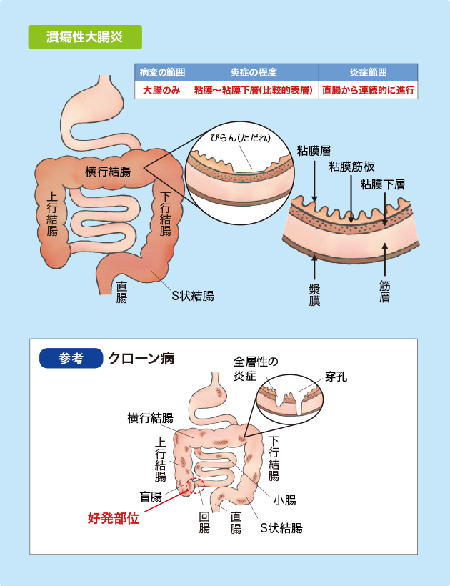 （図）潰瘍性大腸炎の病変