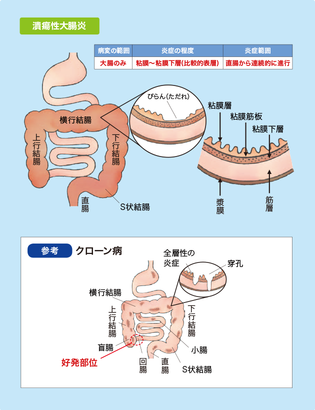 潰瘍性大腸炎