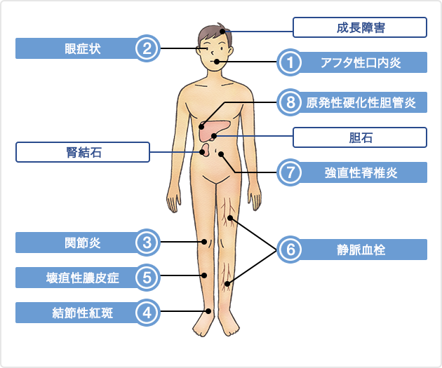 （図）潰瘍性大腸炎の主な腸管外合併症