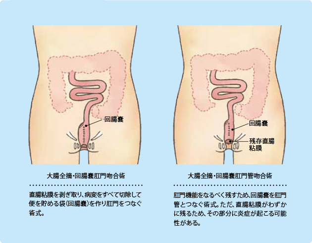 （図）潰瘍性大腸炎の主な術式