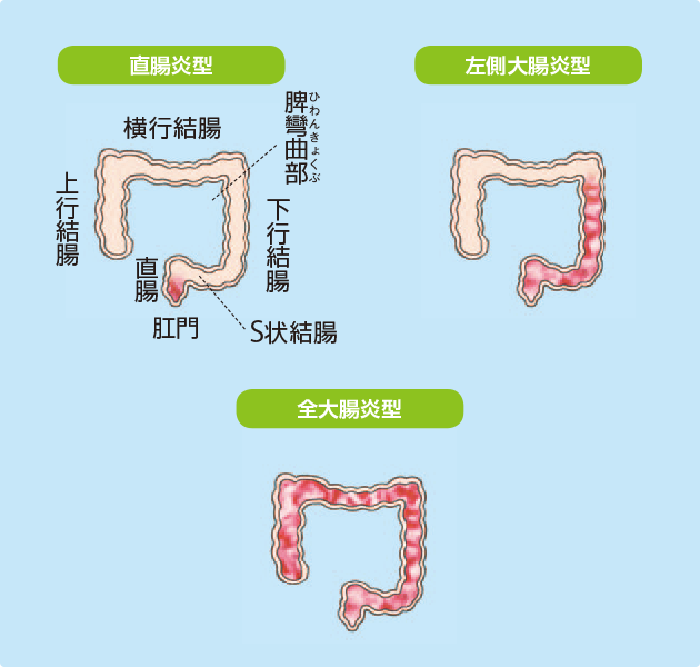 （図）潰瘍性大腸炎の臨床的重症度