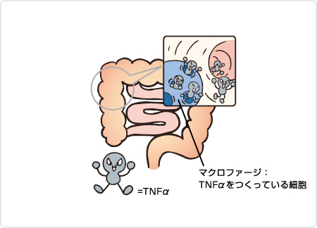 （図）大腸の炎症の中心的役割を担うTNFα